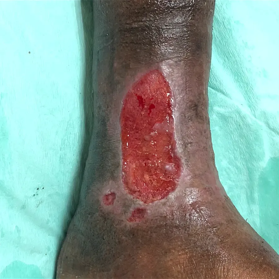 Clinical photograph of a diabetic leg wound at visit 1, HKL-01