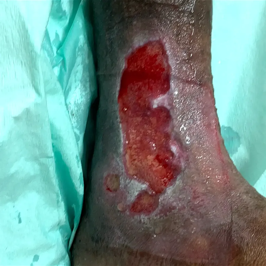 Clinical photograph of a diabetic leg wound at visit 2, HKL-01