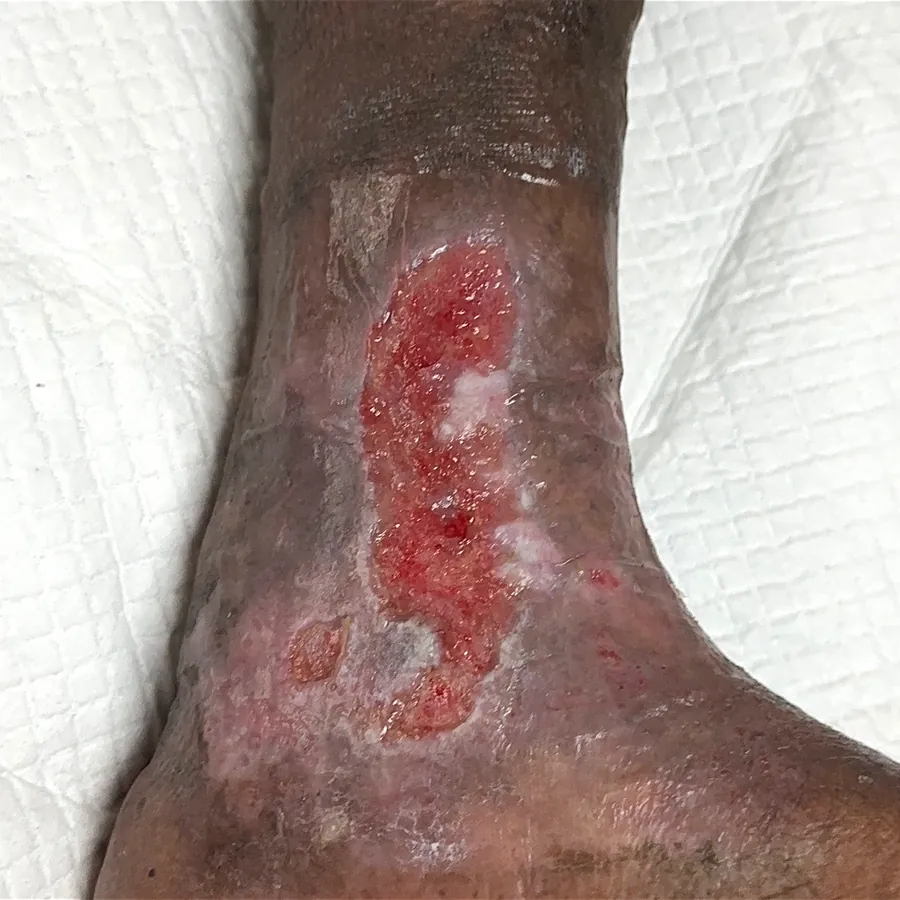 Clinical photograph of a diabetic leg wound at visit 3, HKL-01