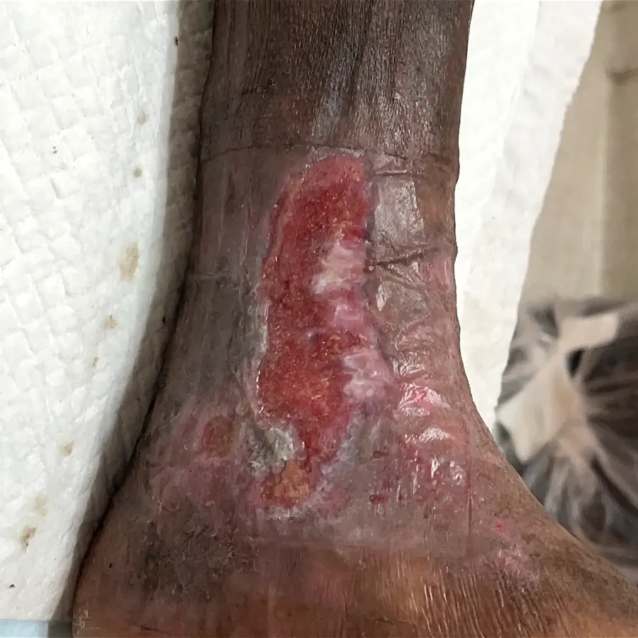 Clinical photograph of a diabetic leg wound at visit 4, HKL-01