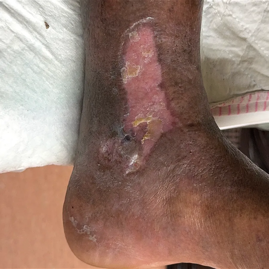 Clinical photograph of a diabetic leg wound at visit 5, HKL-01