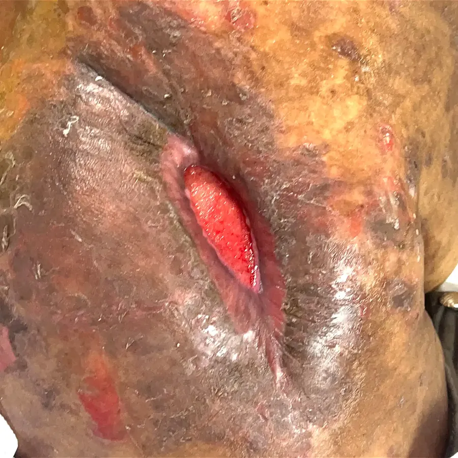 Clinical photograph of a diabetic abdominal wound at visit 1, HKL-02