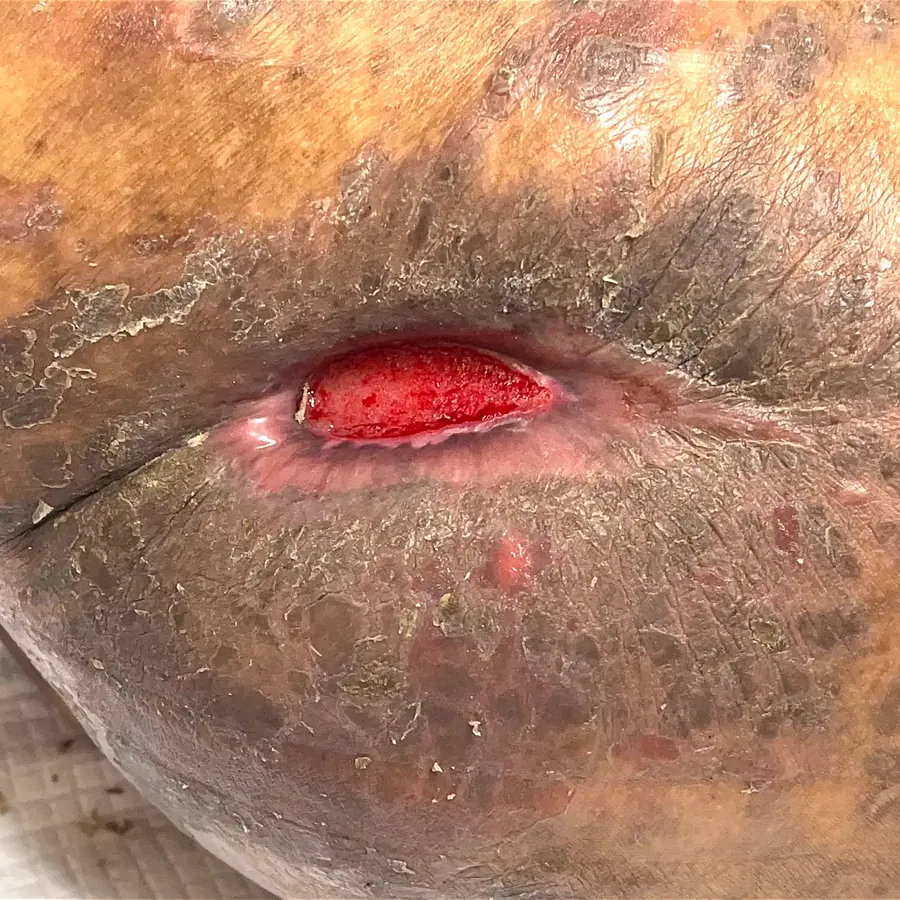 Clinical photograph of a diabetic abdominal wound at visit 2, HKL-02
