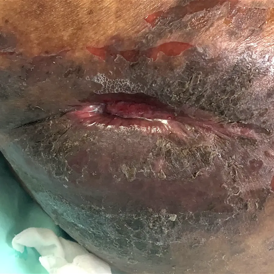 Clinical photograph of a diabetic abdominal wound at visit 3, HKL-02