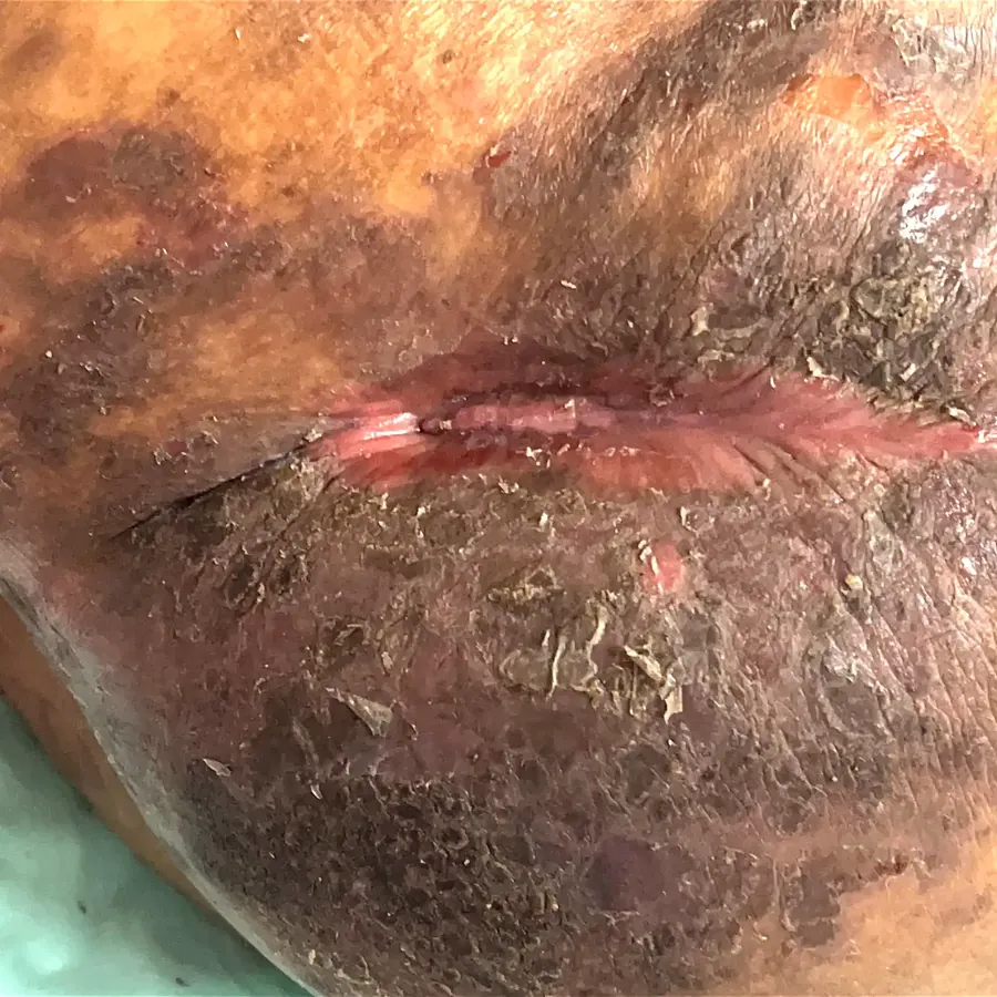 Clinical photograph of a diabetic abdominal wound at visit 4, HKL-02