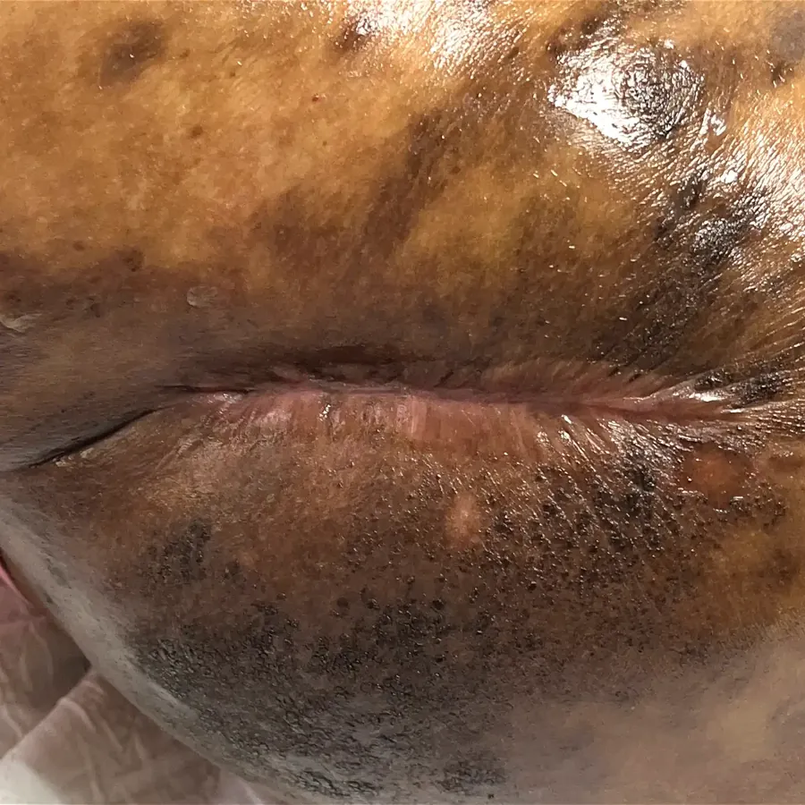 Clinical photograph of a diabetic abdominal wound at visit 5, HKL-02
