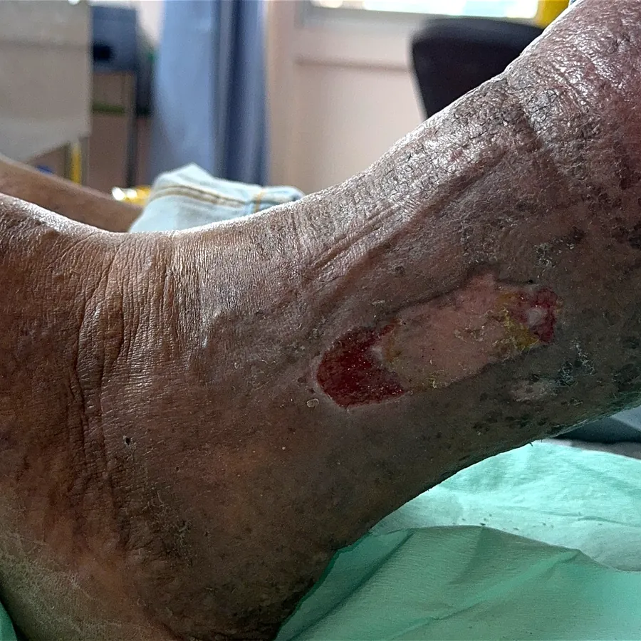 Clinical photograph of a lymphovascular leg wound at visit 1, HKL-03