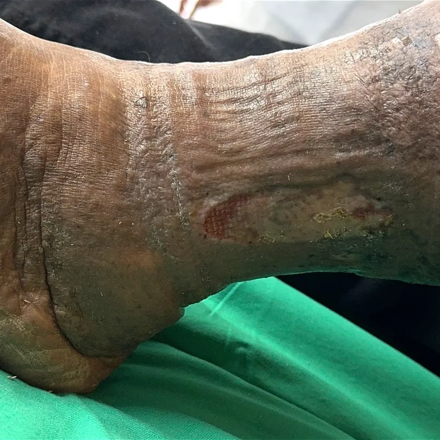 Clinical photograph of a lymphovascular leg wound at visit 2, HKL-03