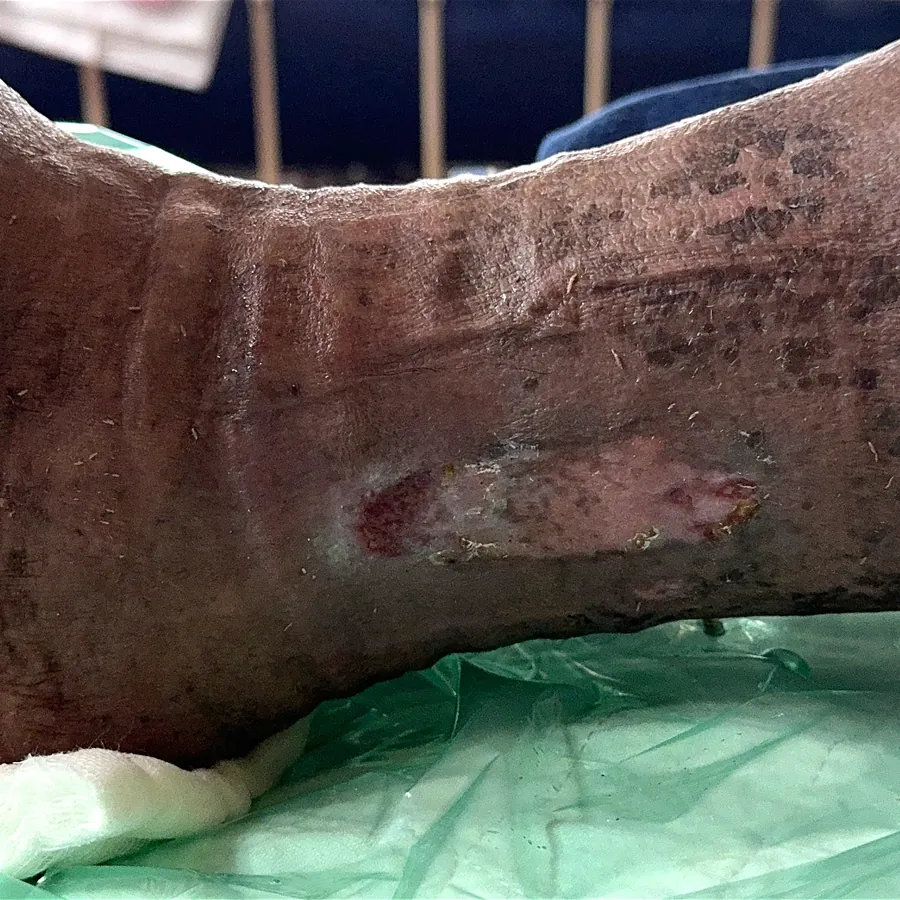 Clinical photograph of a lymphovascular leg wound at visit 3, HKL-03