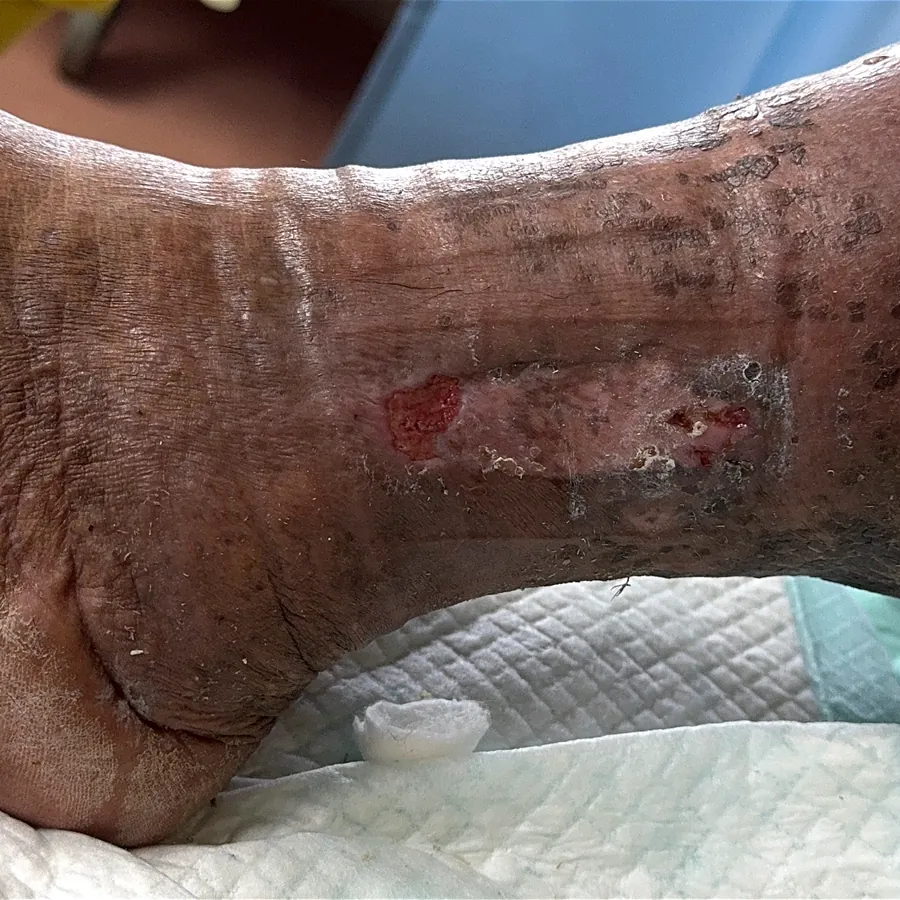 Clinical photograph of a lymphovascular leg wound at visit 4, HKL-03