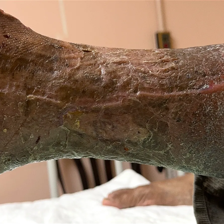Clinical photograph of a lymphovascular leg wound at visit 5, HKL-03