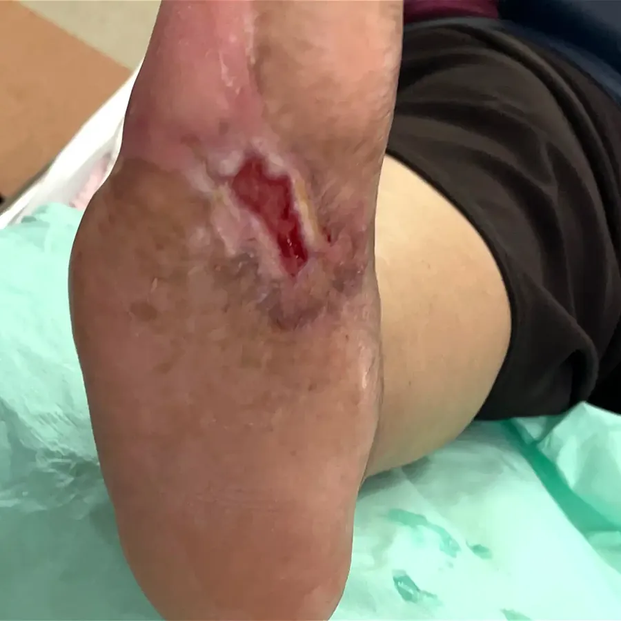 Clinical photograph of a diabetic plantar wound at visit 1, HKL-04