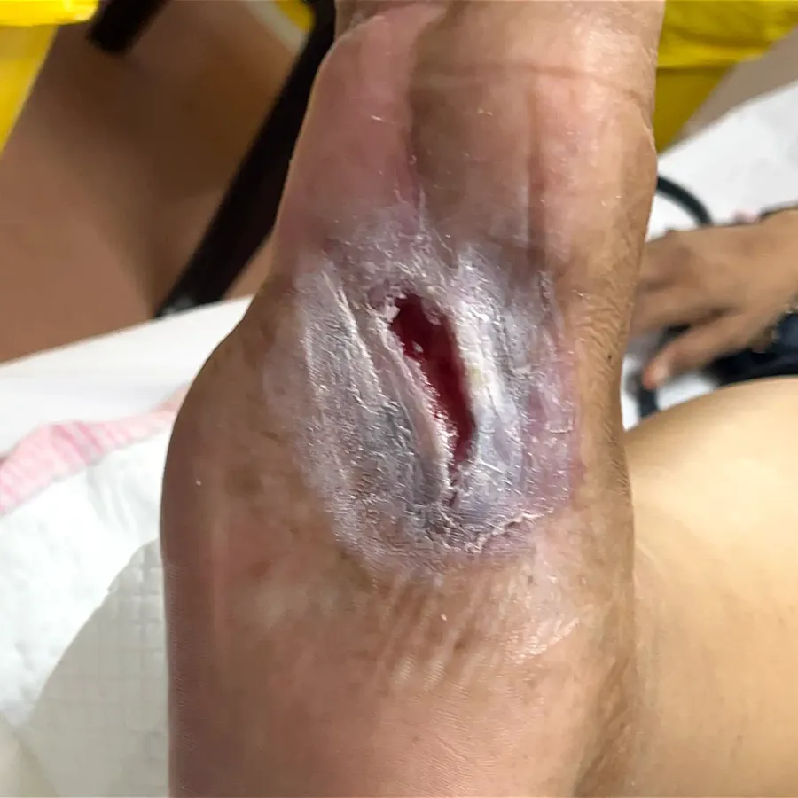 Clinical photograph of a diabetic plantar wound at visit 2, HKL-04