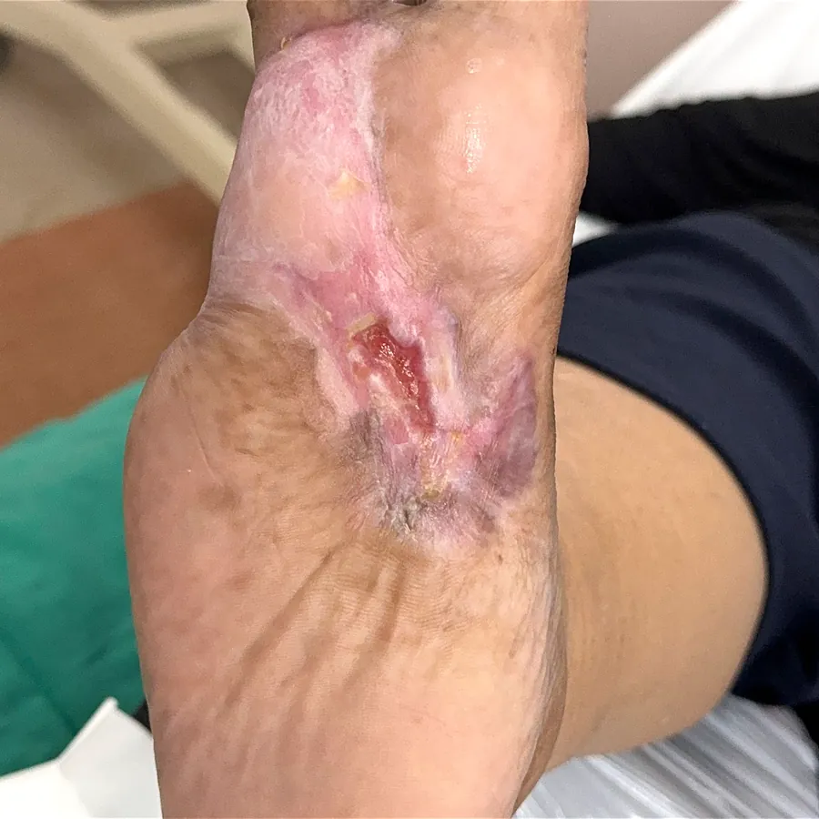 Clinical photograph of a diabetic plantar wound at visit 3, HKL-04