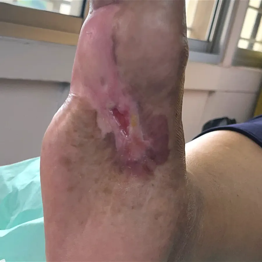 Clinical photograph of a diabetic plantar wound at visit 4, HKL-04
