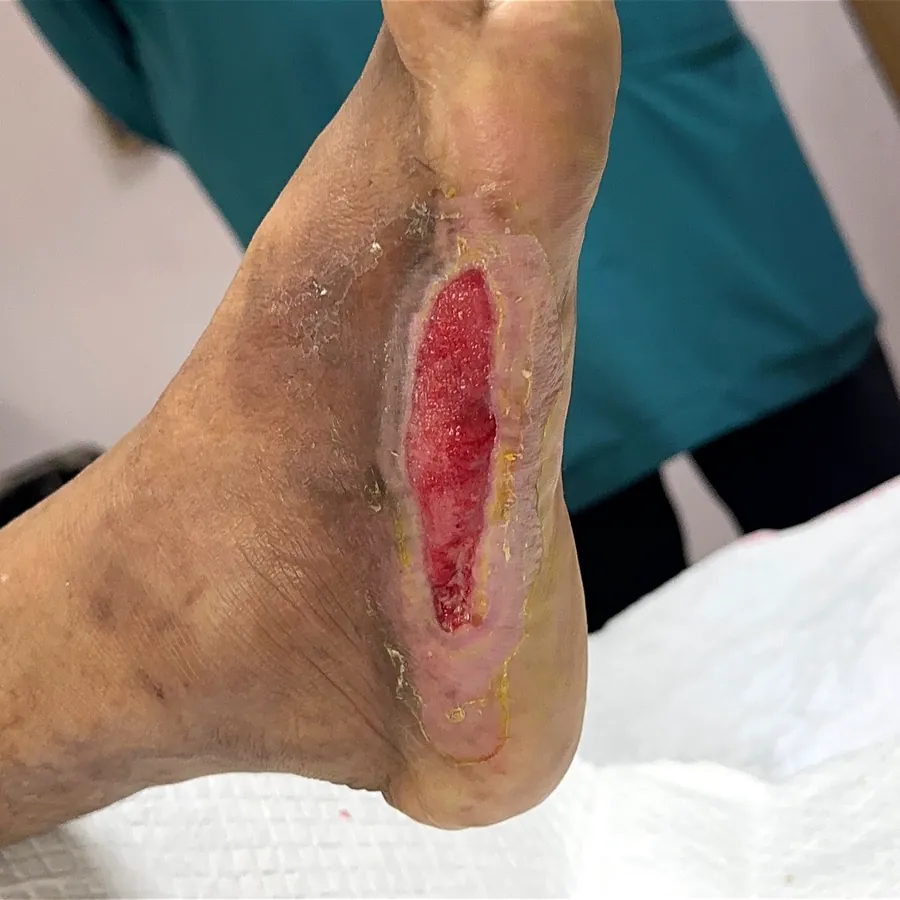 Clinical photograph of a diabetic plantar wound at visit 1, HKL-05