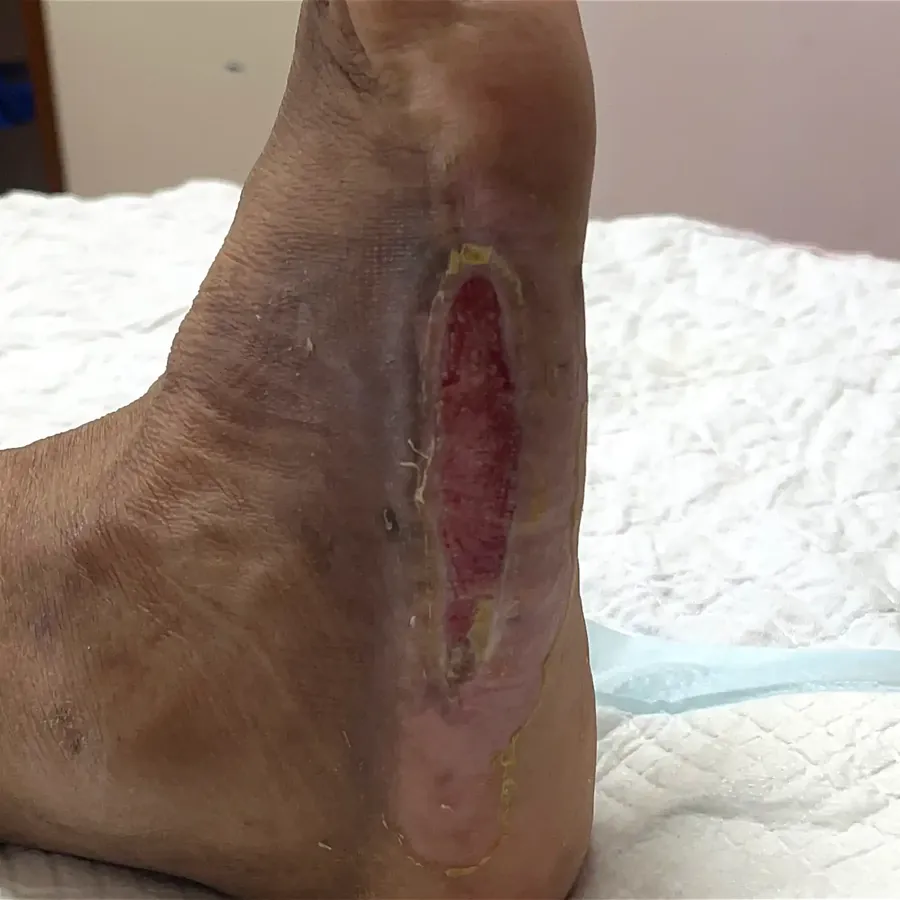 Clinical photograph of a diabetic plantar wound at visit 2, HKL-05