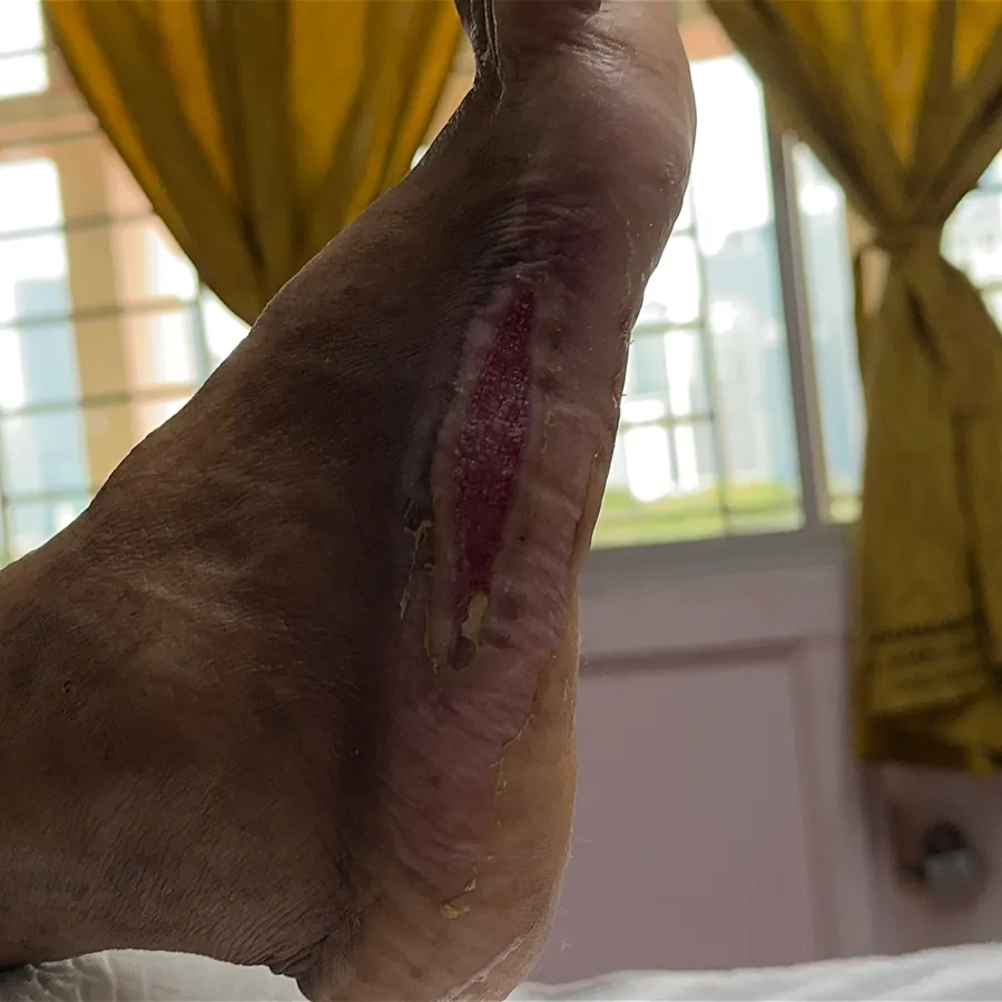 Clinical photograph of a diabetic plantar wound at visit 3, HKL-05