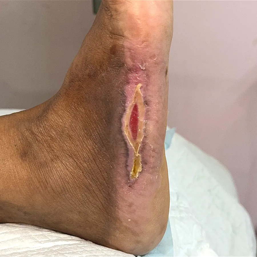 Clinical photograph of a diabetic plantar wound at visit 4, HKL-05