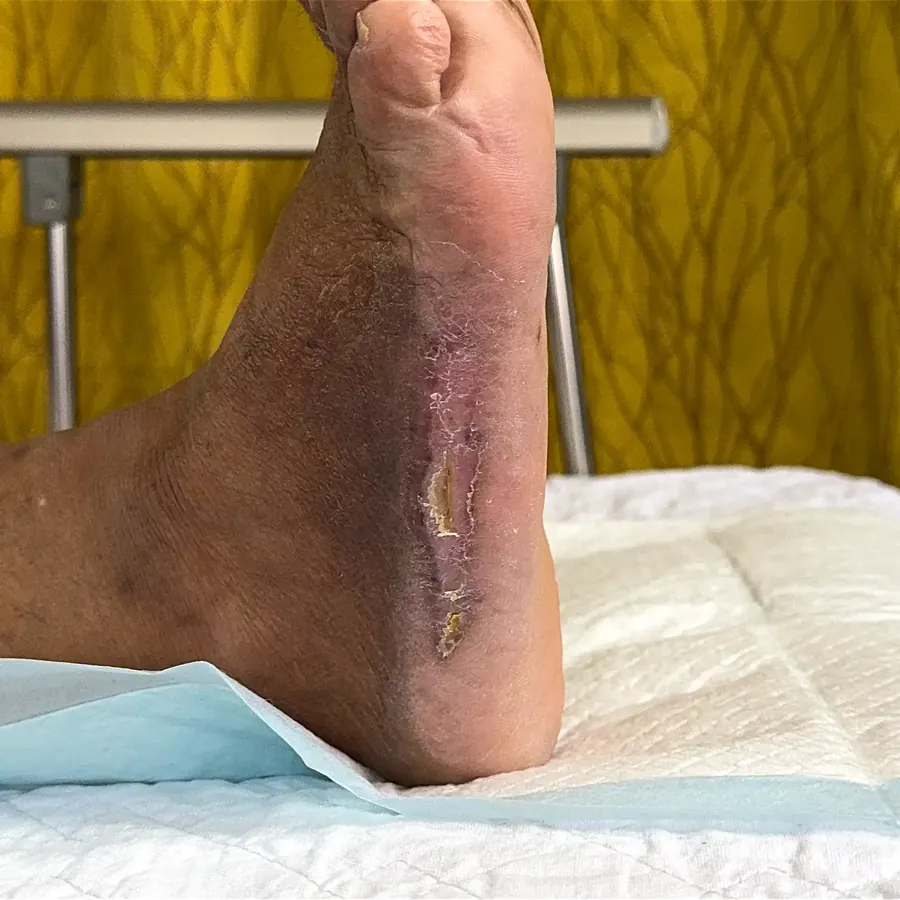 Clinical photograph of a diabetic plantar wound at visit 5, HKL-05