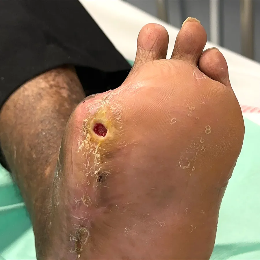 Clinical photograph of a diabetic plantar wound at visit 1, HKL-06