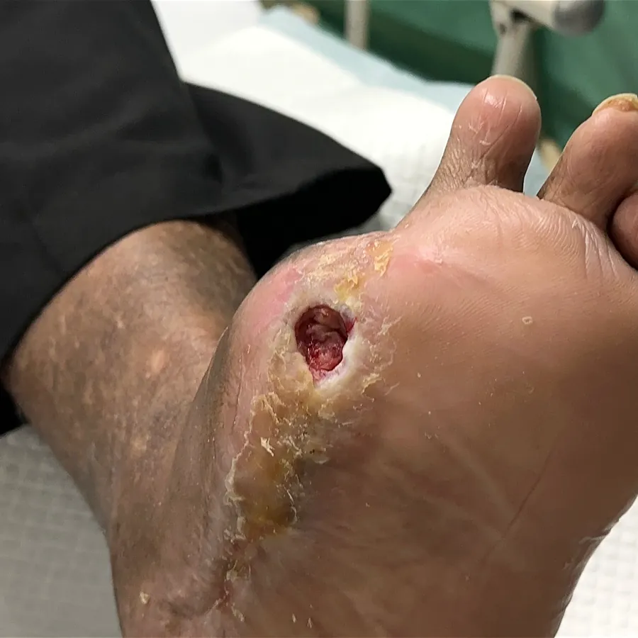 Clinical photograph of a diabetic plantar wound at visit 2, HKL-06