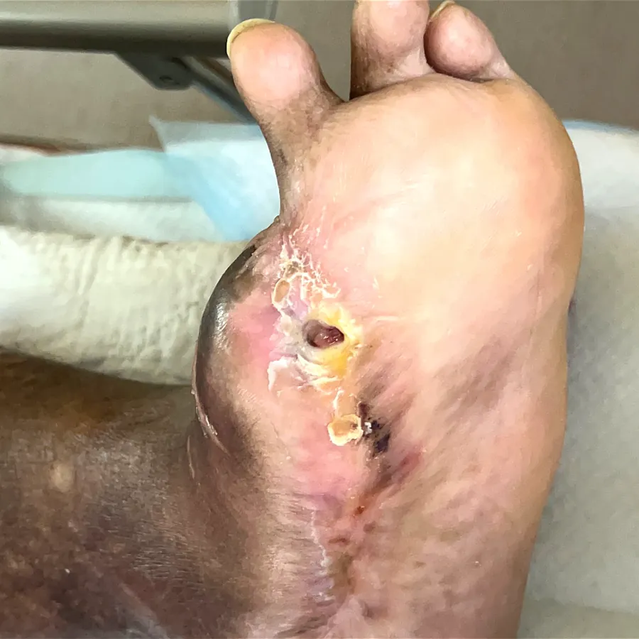 Clinical photograph of a diabetic plantar wound at visit 3, HKL-06