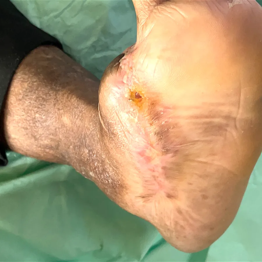 Clinical photograph of a diabetic plantar wound at visit 4, HKL-06