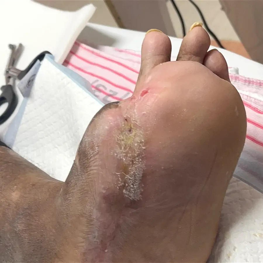 Clinical photograph of a diabetic plantar wound at visit 5, HKL-06