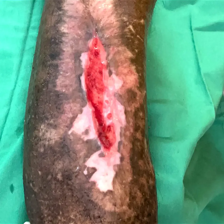 Clinical photograph of a diabetic leg wound at visit 1, HKL-07