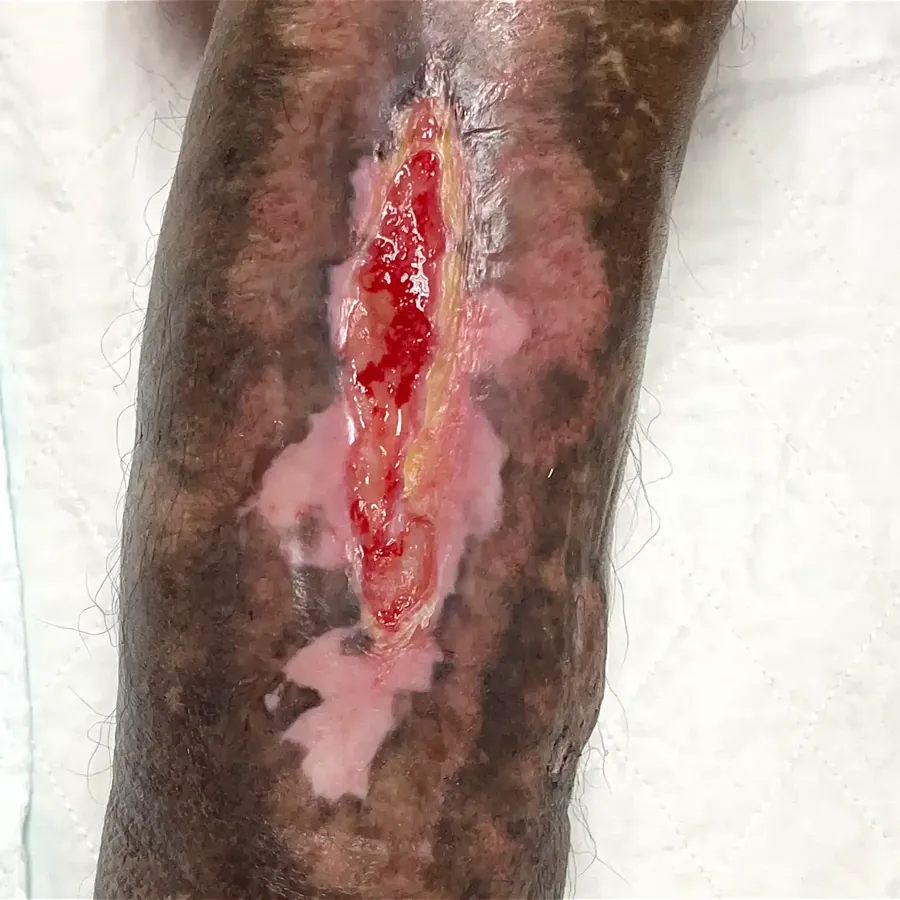 Clinical photograph of a diabetic leg wound at visit 2, HKL-07