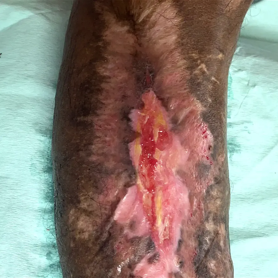 Clinical photograph of a diabetic leg wound at visit 3, HKL-07