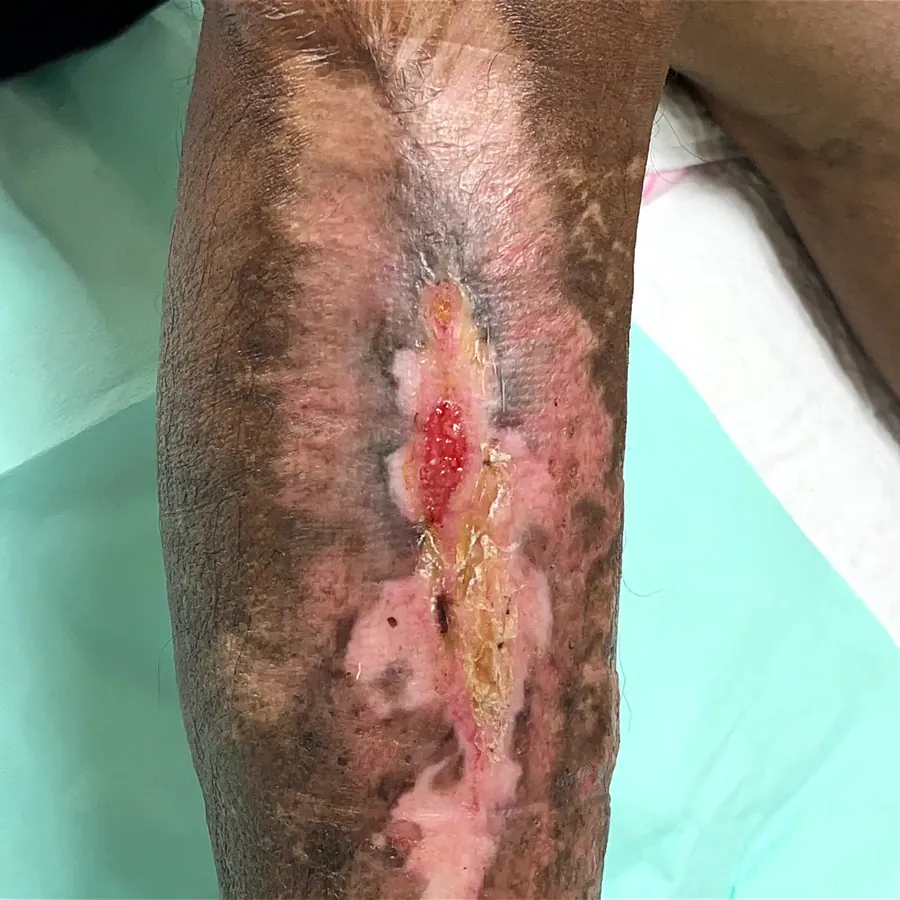 Clinical photograph of a diabetic leg wound at visit 4, HKL-07