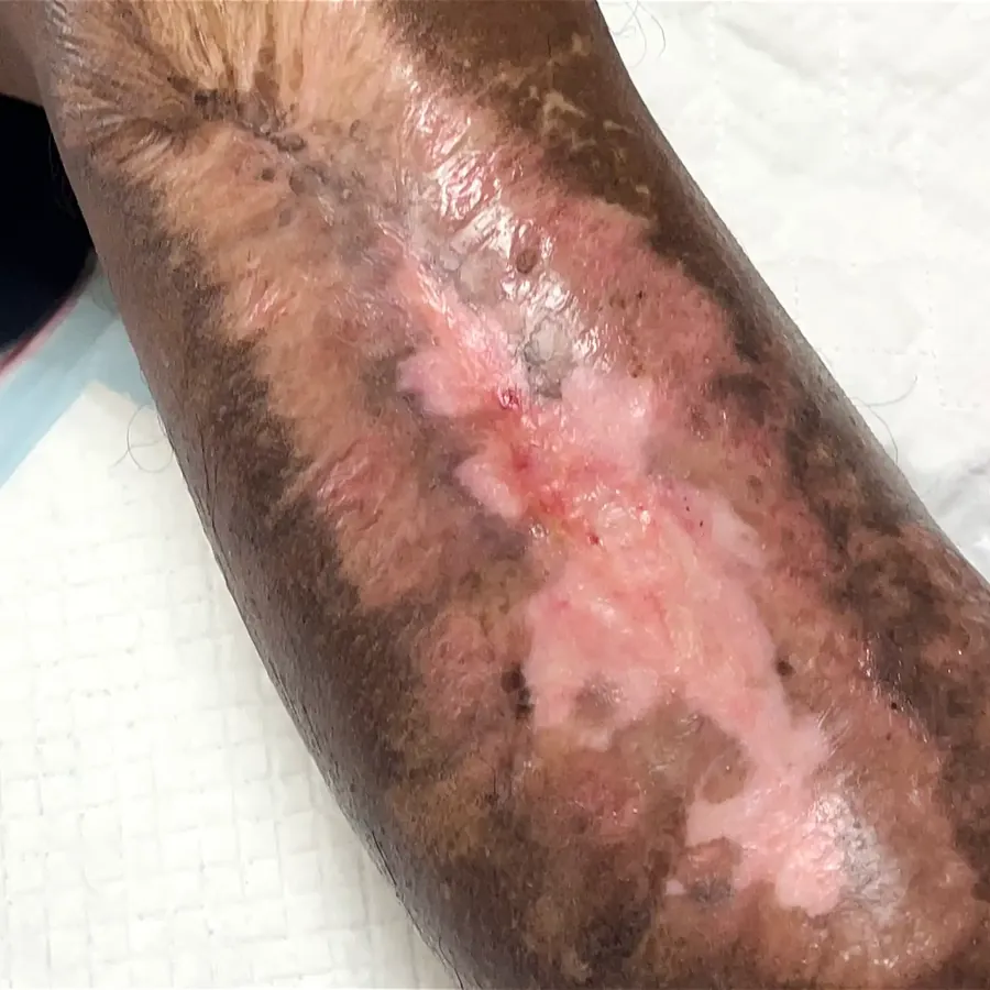 Clinical photograph of a diabetic leg wound at visit 5, HKL-07