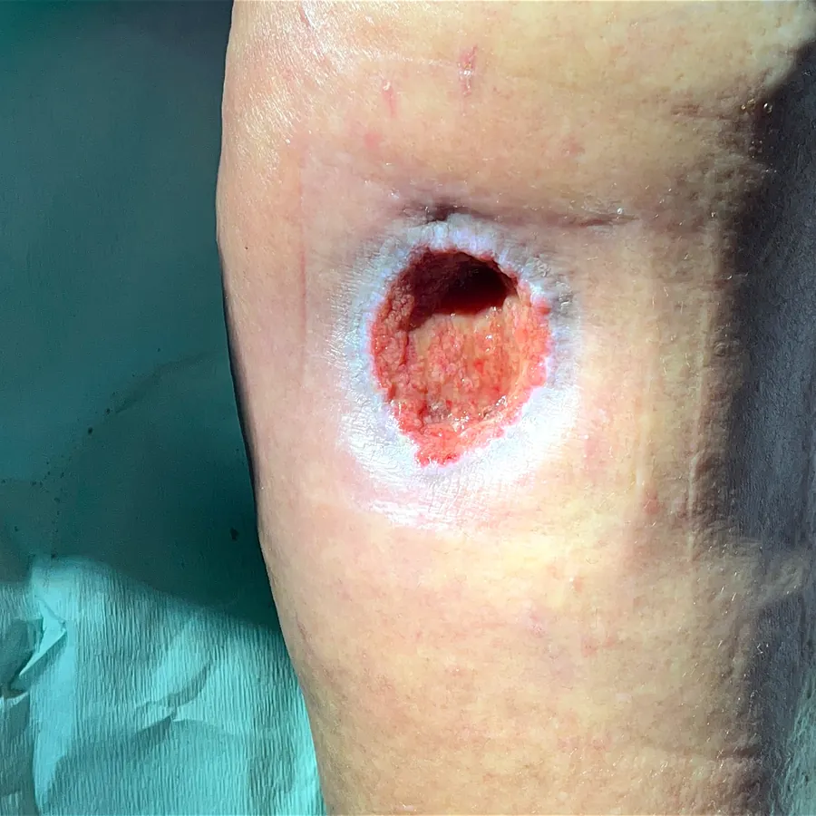 Clinical photograph of a diabetic leg wound at visit 1, HKL-08