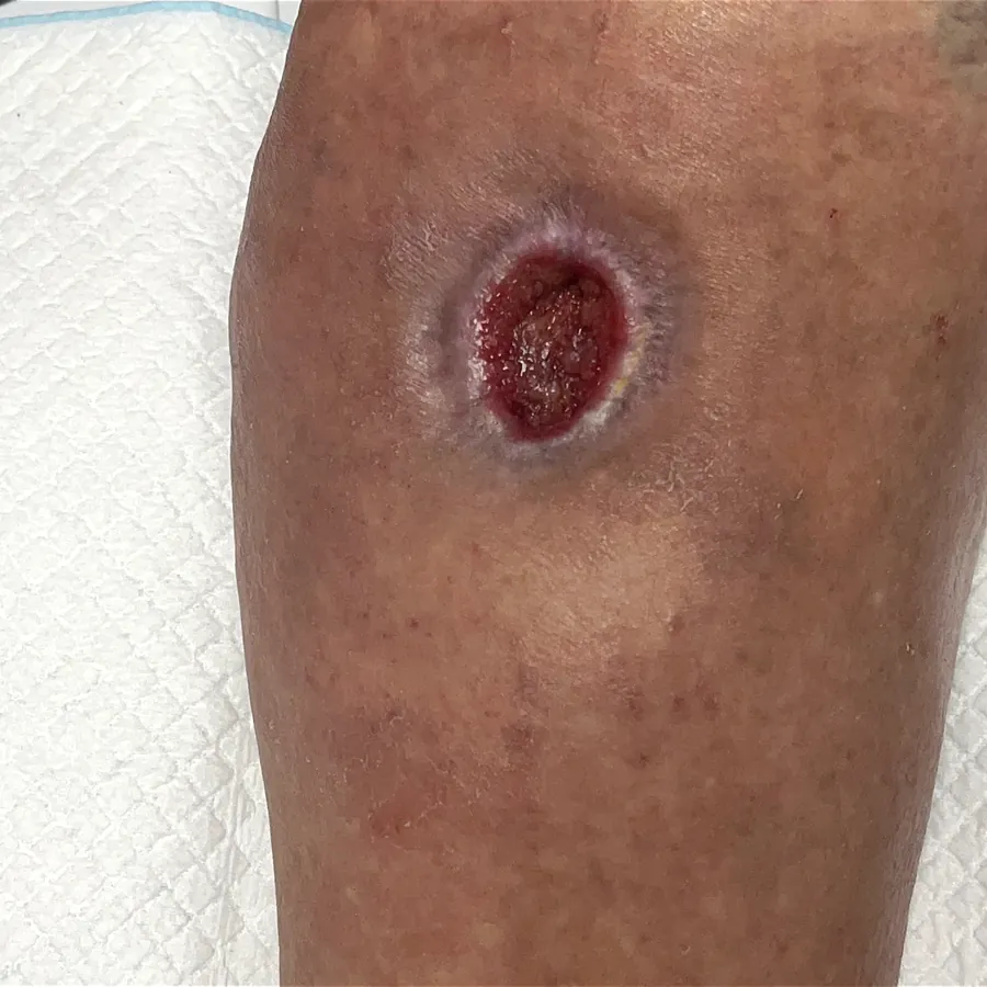 Clinical photograph of a diabetic leg wound at visit 2, HKL-08