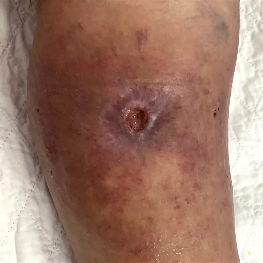 Clinical photograph of a diabetic leg wound at visit 3, HKL-08