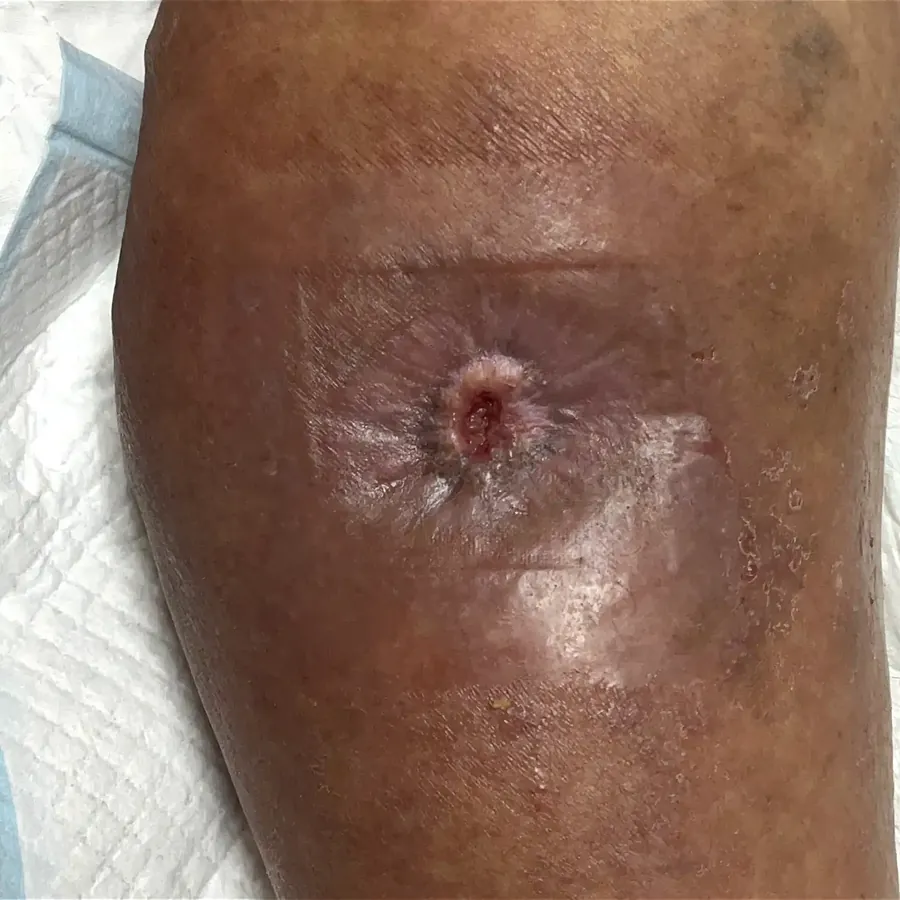 Clinical photograph of a diabetic leg wound at visit 4, HKL-08
