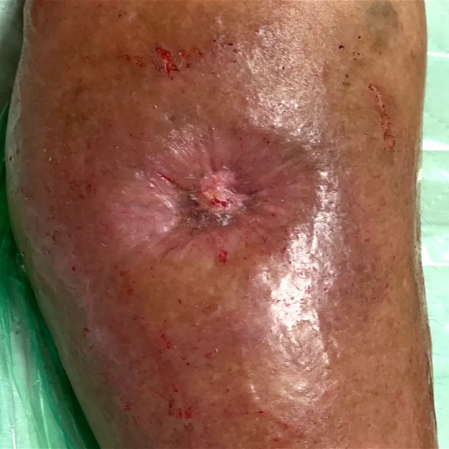 Clinical photograph of a diabetic leg wound at visit 5, HKL-08