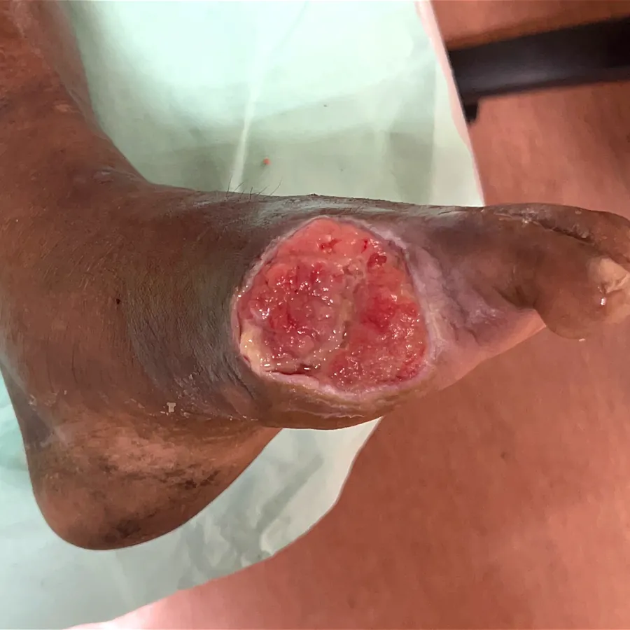 Clinical photograph of a diabetic foot wound at visit 1, HKL-09