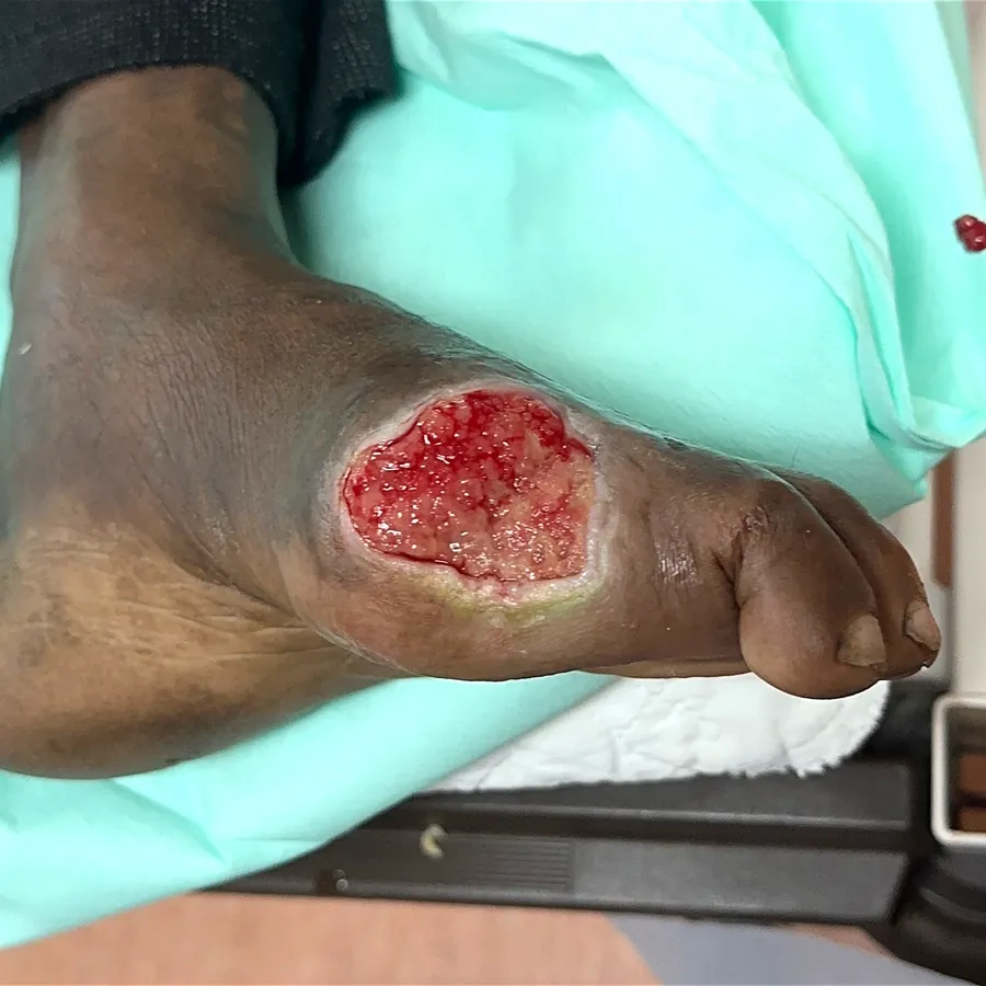 Clinical photograph of a diabetic foot wound at visit 2, HKL-09
