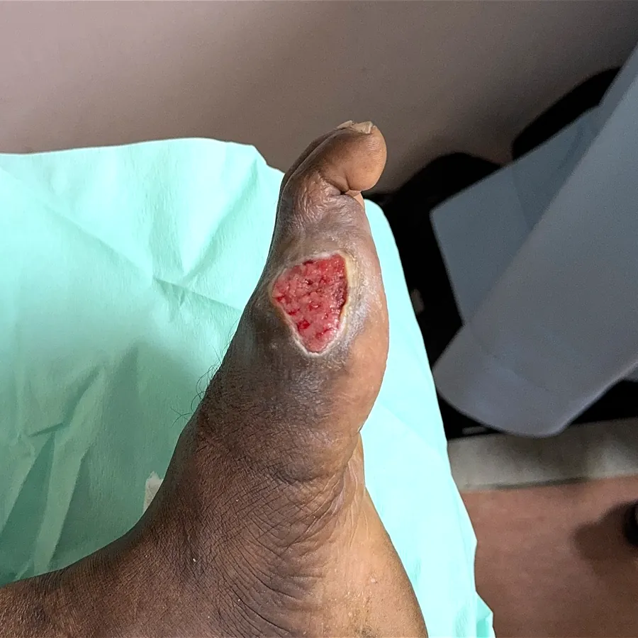 Clinical photograph of a diabetic foot wound at visit 3, HKL-09