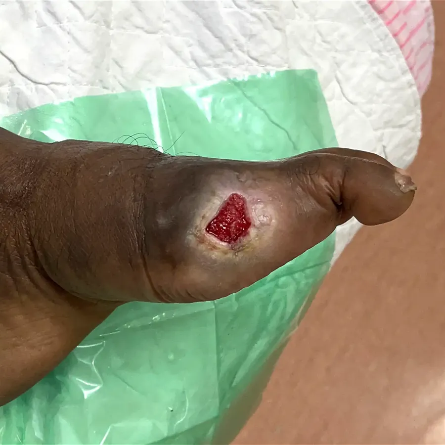 Clinical photograph of a diabetic foot wound at visit 4, HKL-09