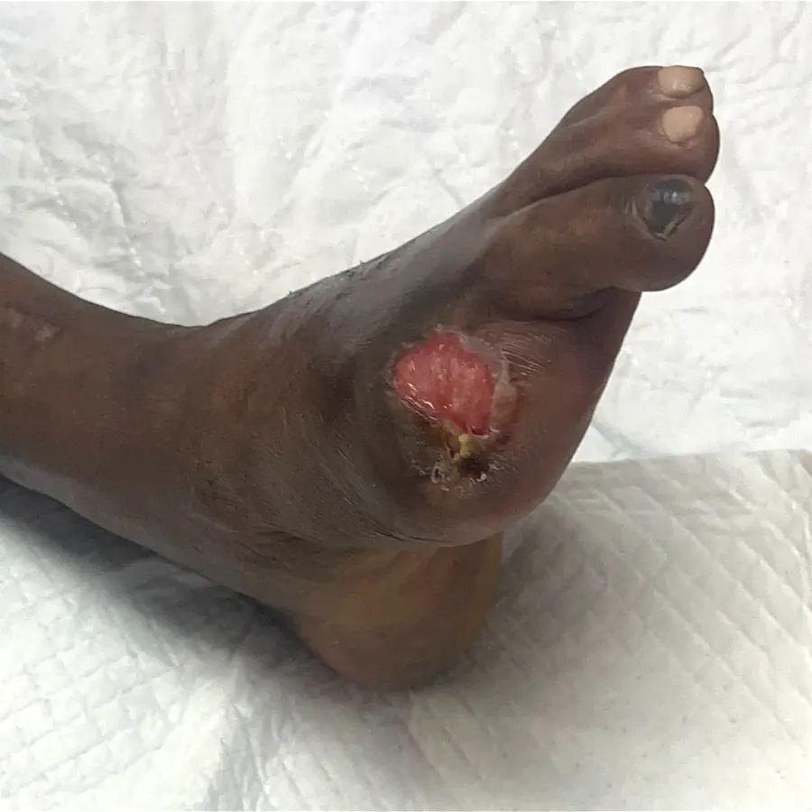 Clinical photograph of a diabetic foot wound at visit 5, HKL-09