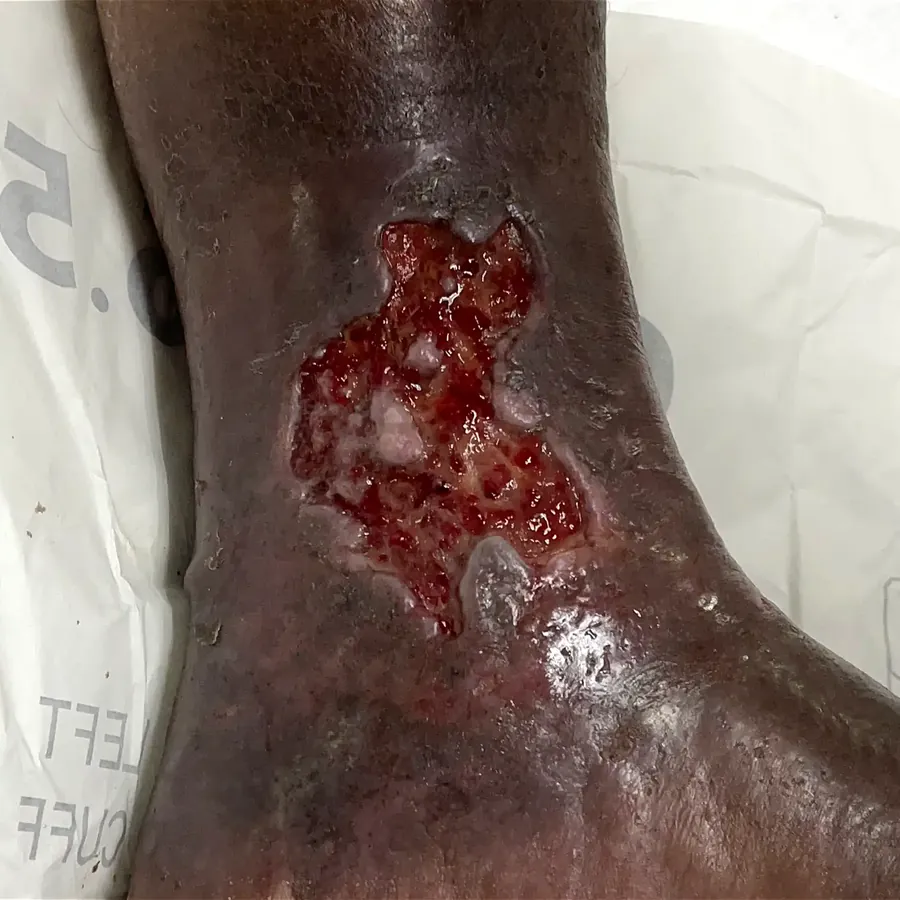 Clinical photograph of a lymphovascular leg wound at visit 1, HKL-10