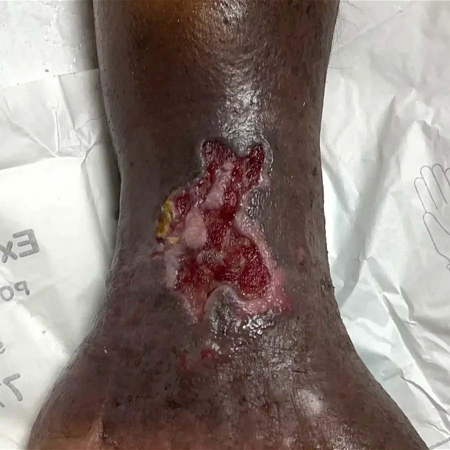 Clinical photograph of a lymphovascular leg wound at visit 2, HKL-10