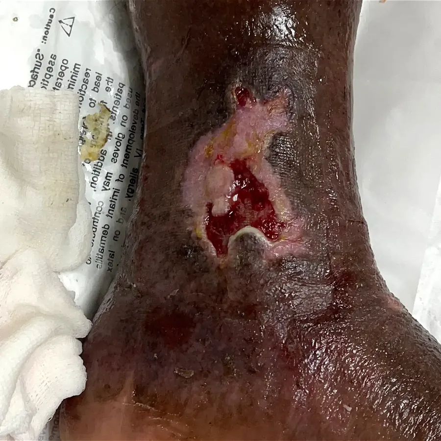 Clinical photograph of a lymphovascular leg wound at visit 3, HKL-10