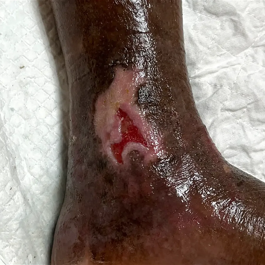 Clinical photograph of a lymphovascular leg wound at visit 4, HKL-10