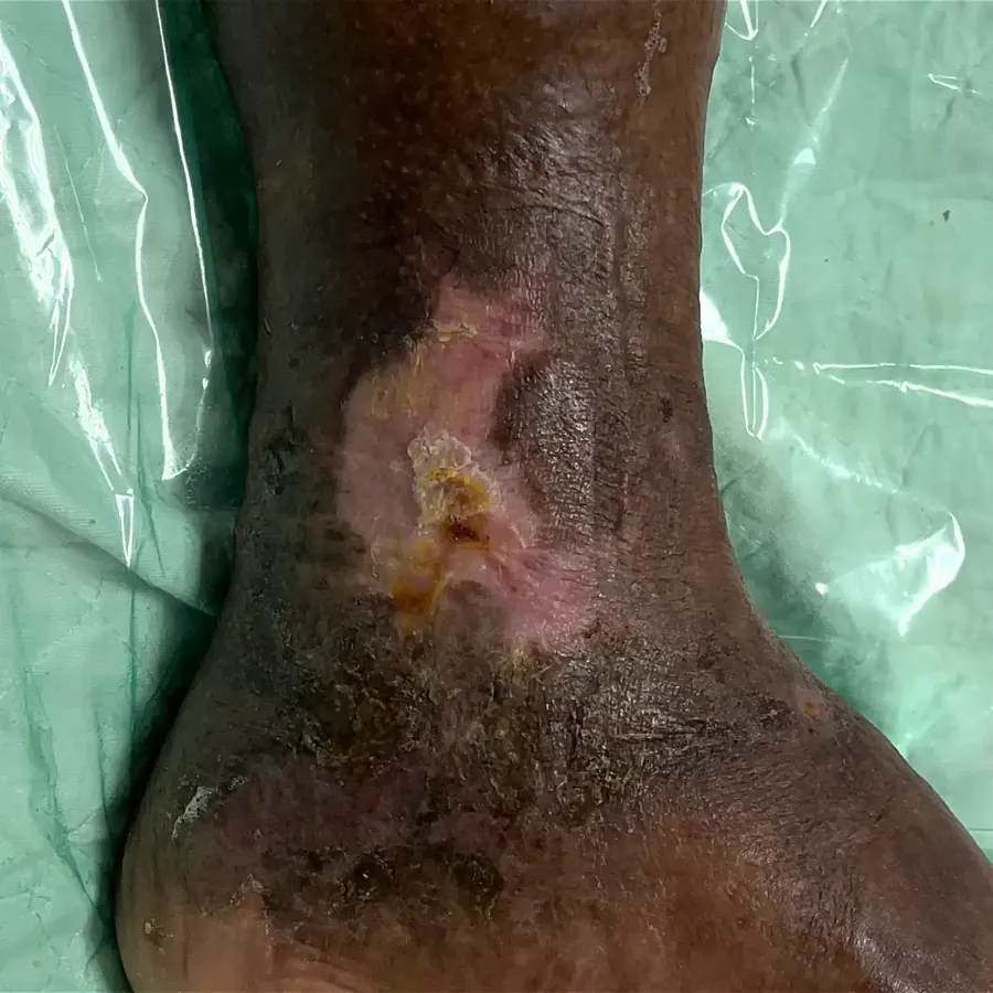 Clinical photograph of a lymphovascular leg wound at visit 5, HKL-10