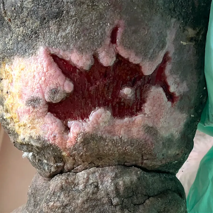 Clinical photograph of a lymphovascular leg wound at visit 1, HKL-11